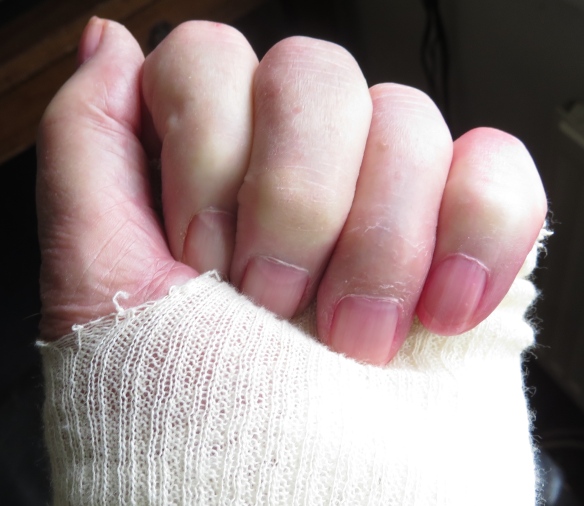 Fist in bandage